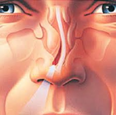 Искривление носовой перегородки 