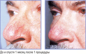 Купероз, причины, симптомы, лечение купероза на лице